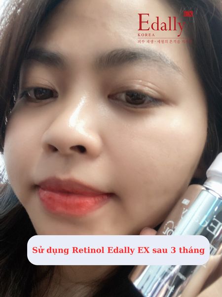 Feedback khách hàng - Tái sinh làn da thâm mụn với Retinol Edally EX
